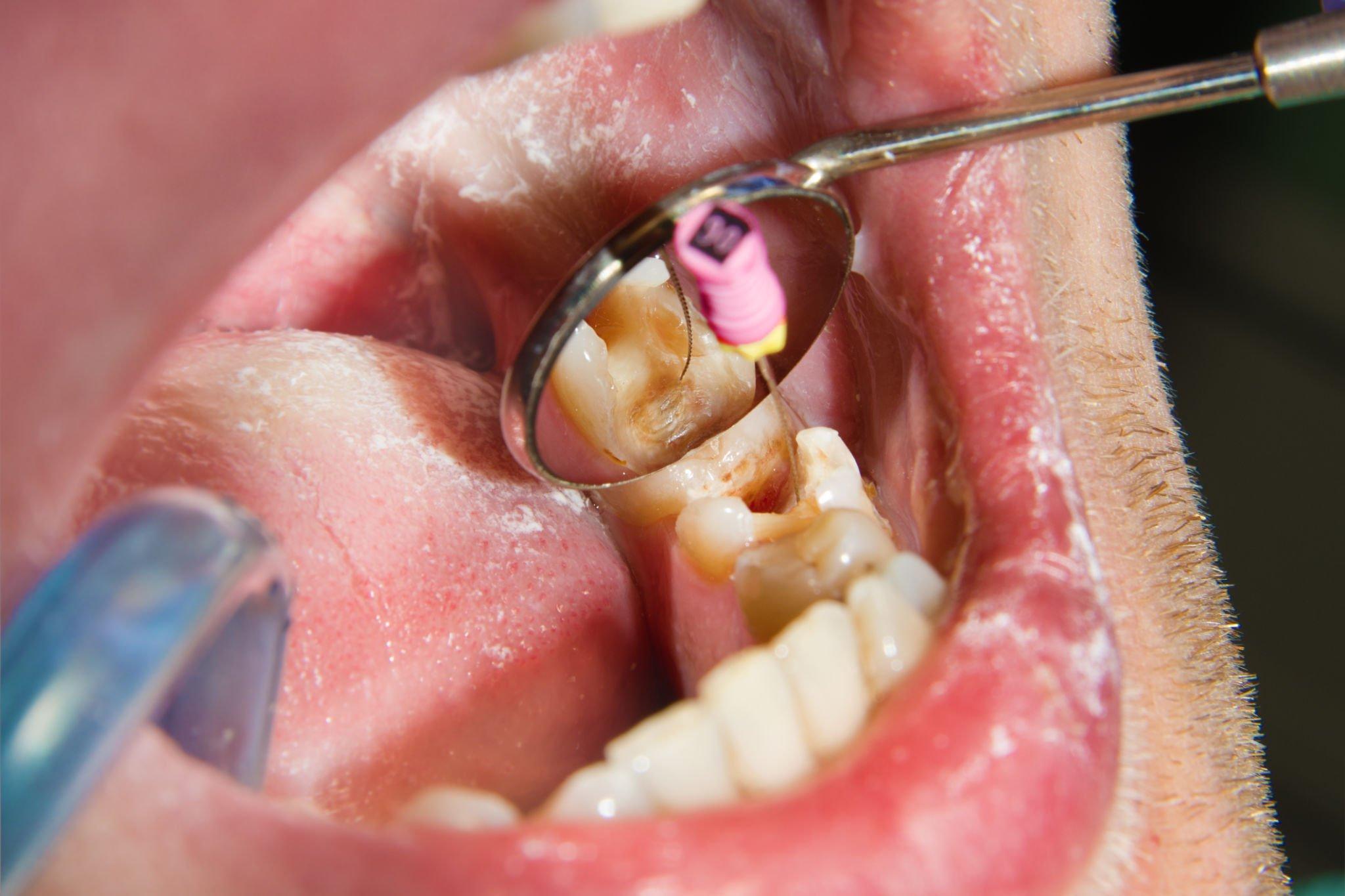 Warning: These 9 Mistakes Will Destroy Your local teeth cleaning